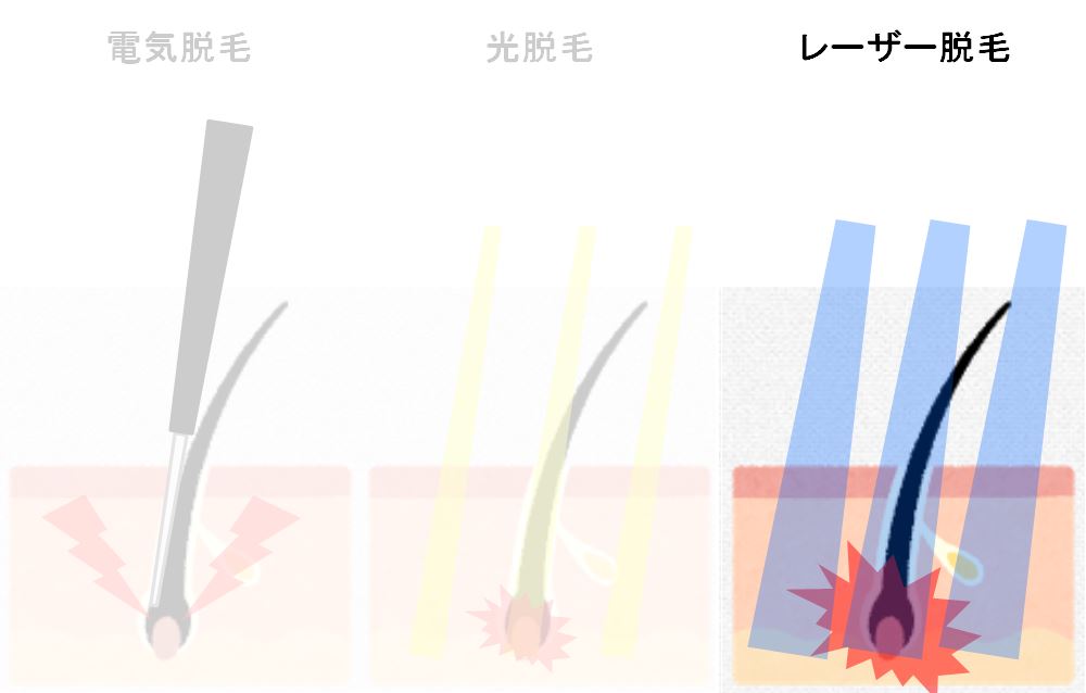 レーザー脱毛図
