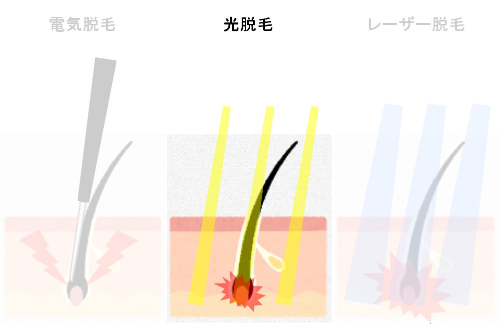 光脱毛図