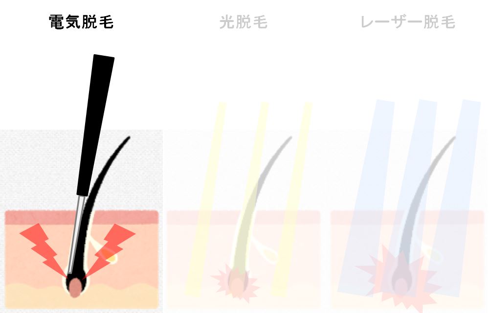 電気脱毛図