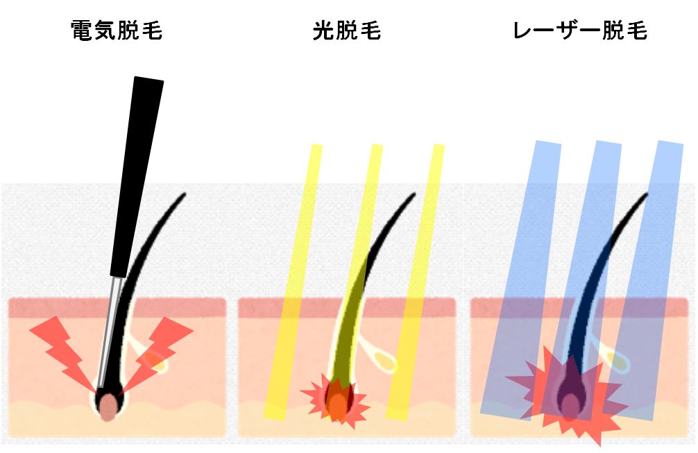 髭脱毛の方法