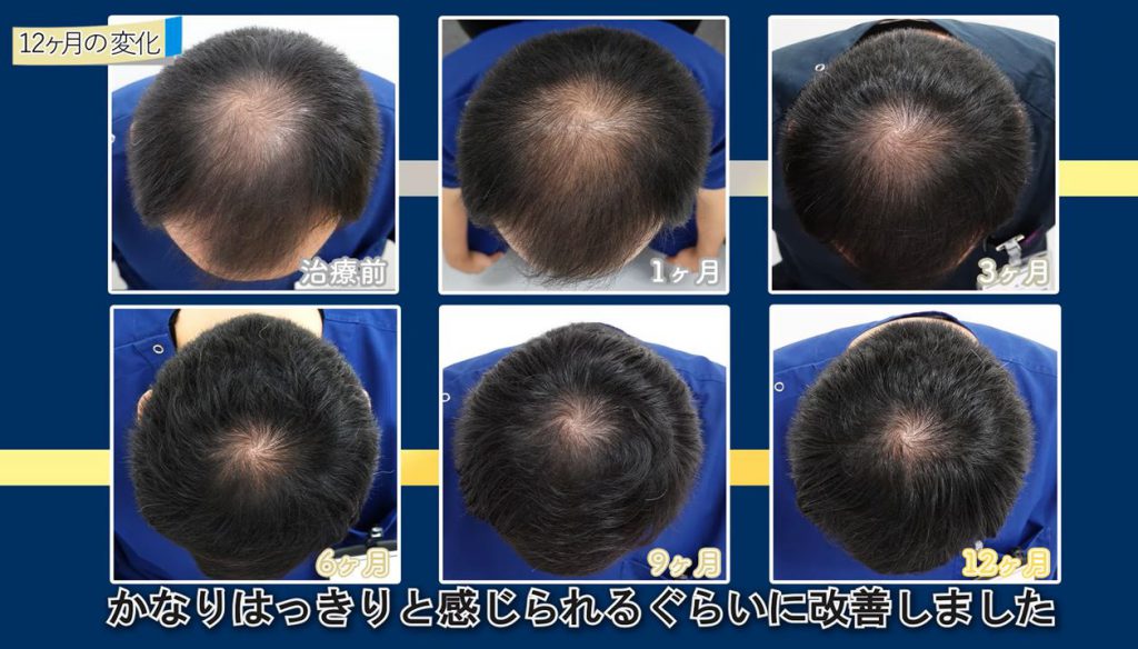 AGA治療期間と髪の毛の改善状況