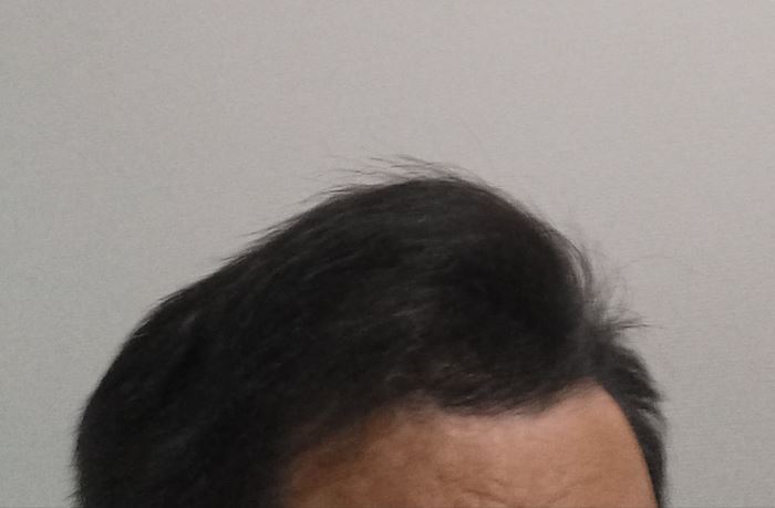 プロペシアを服用している筆者の髪の状態